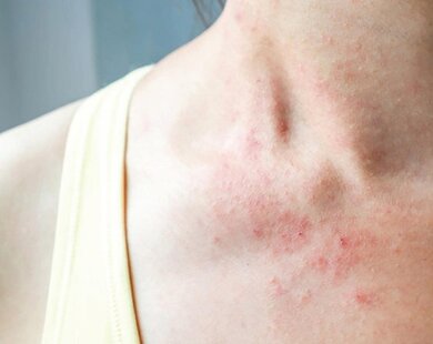 Cách điều trị viêm da dị ứng mà không làm tổn hại lớp bảo vệ da