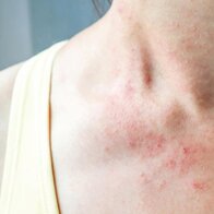 Cách điều trị viêm da dị ứng mà không làm tổn hại lớp bảo vệ da