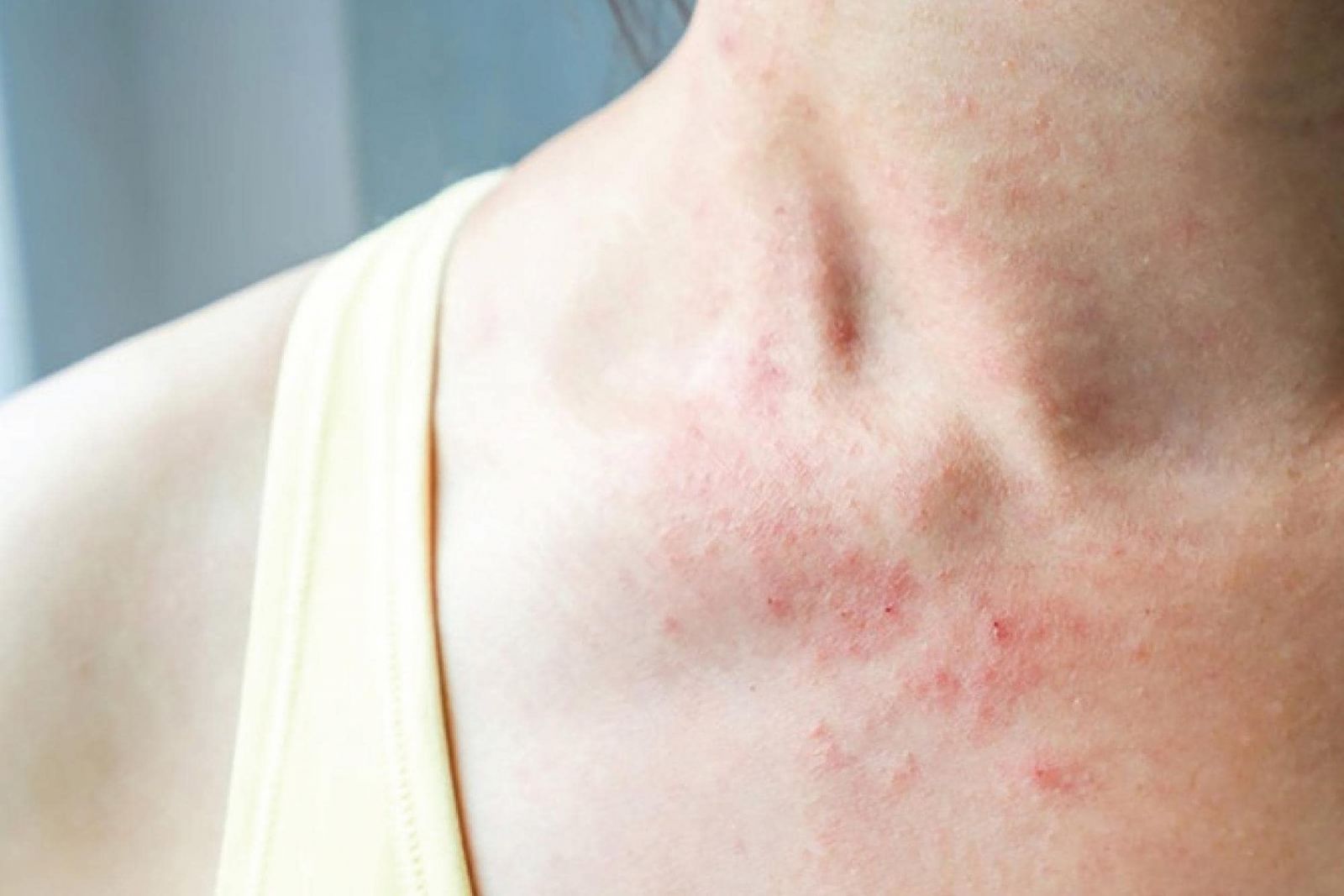 Cách điều trị viêm da dị ứng mà không làm tổn hại lớp bảo vệ da